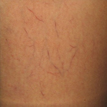 Sclerotherapy before