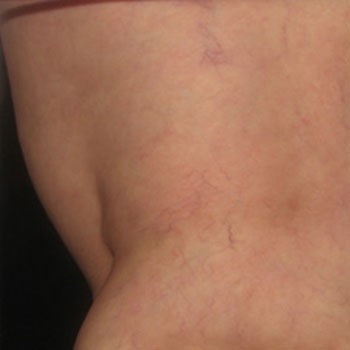 Sclerotherapy after